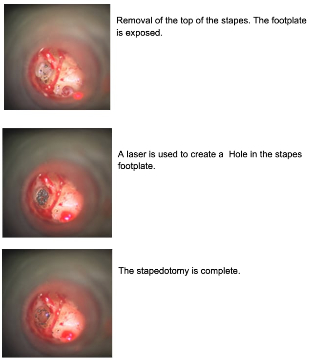 Stapedectomy