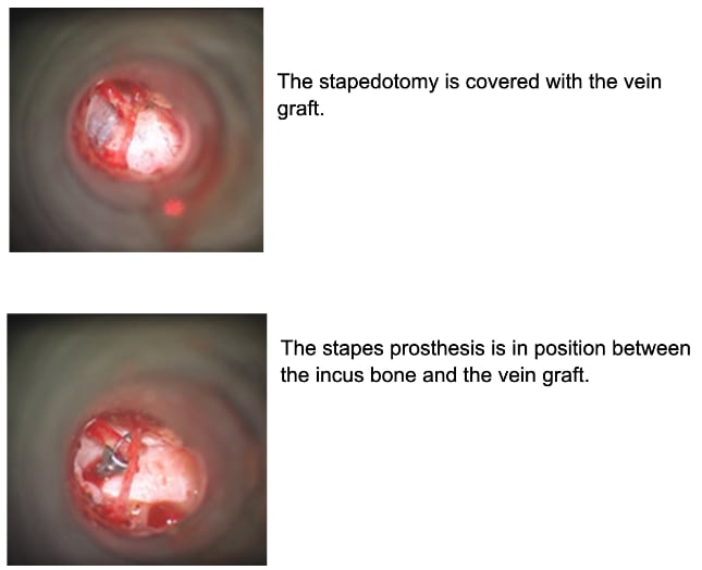 Stapedectomy