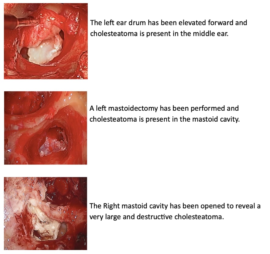 Cholesteatoma Surgery Images Ear Associates Rehabilitation Services Cholesteatoma Surgery Images Ear Associates Rehabilitation Services