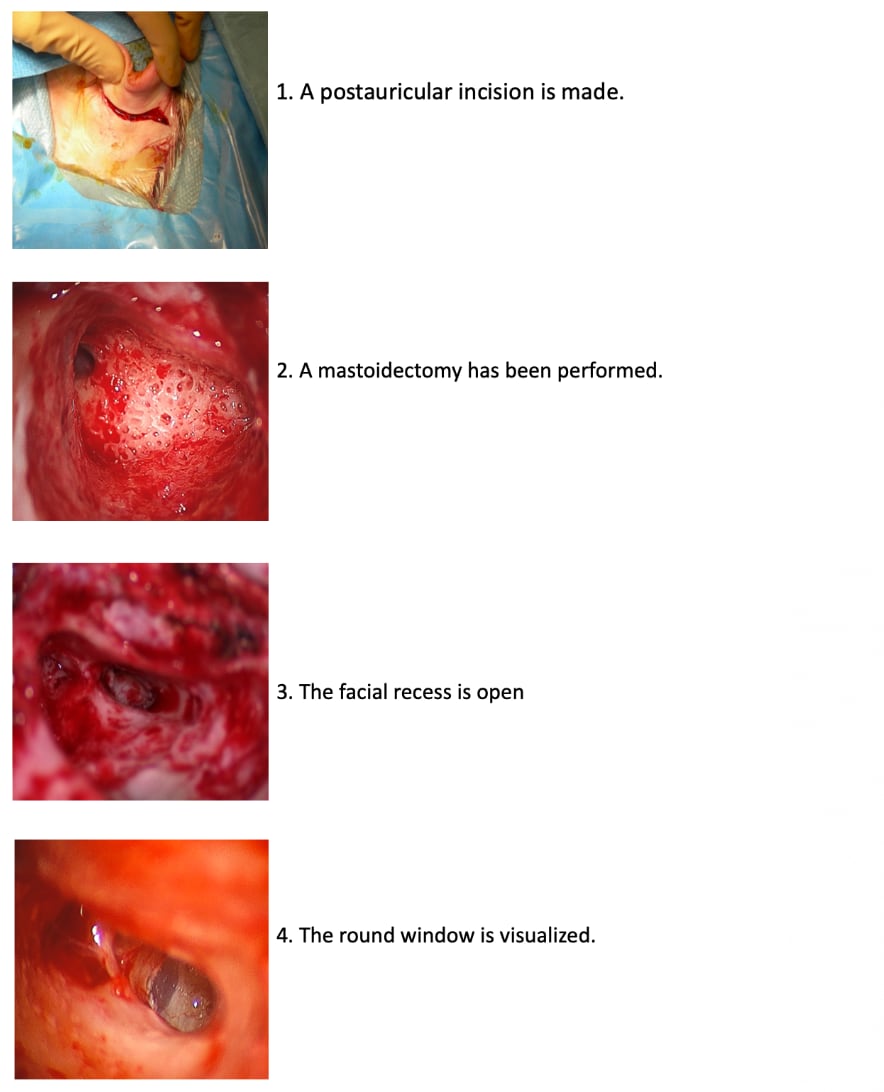 cochlear Implant Images