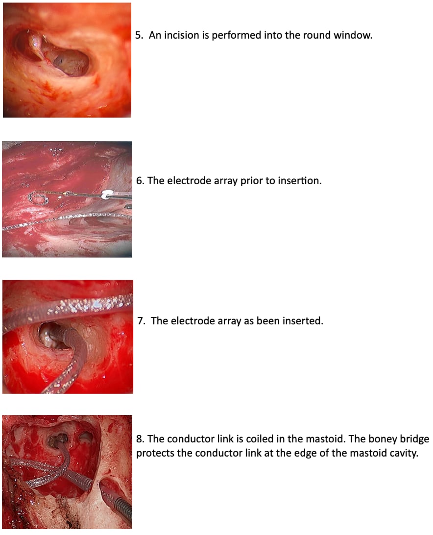 cochlear Implant Images