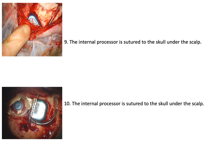 cochlear Implant Images