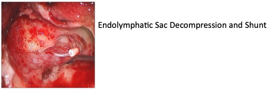 Endolymphatic Sac Decompression and Shunt