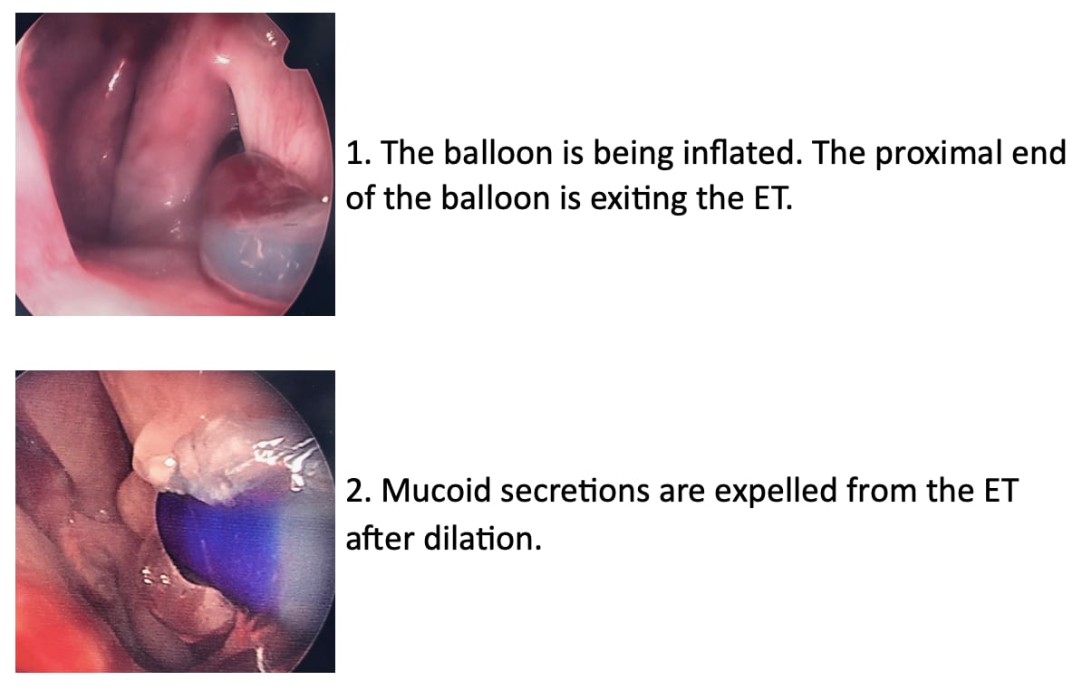 Expelled Mucoid Fluid