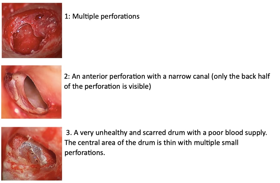 Lateral Tympanoplasty Images