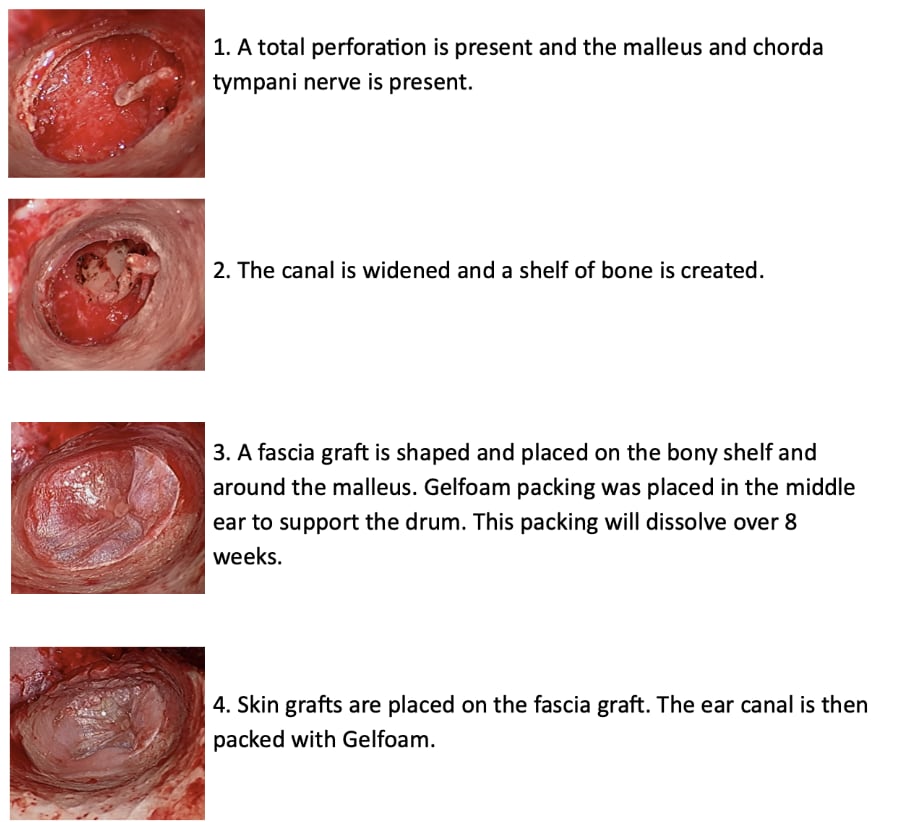 Lateral Tympanoplasty Images