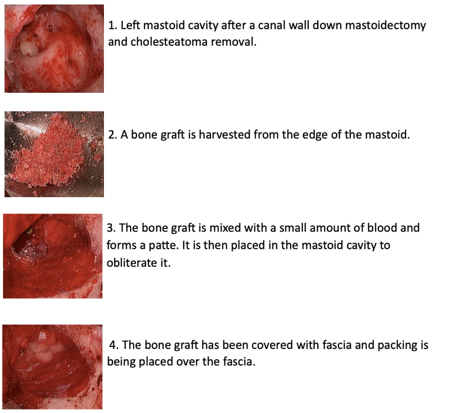 Mastoid Obliteration