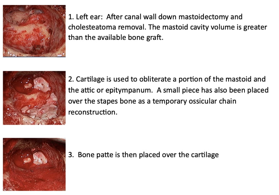 Mastoidectomy