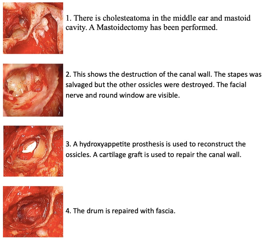 Tympanoatticotomy