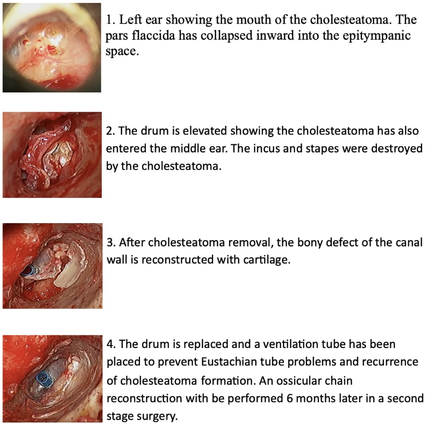 Tympanoatticotomy