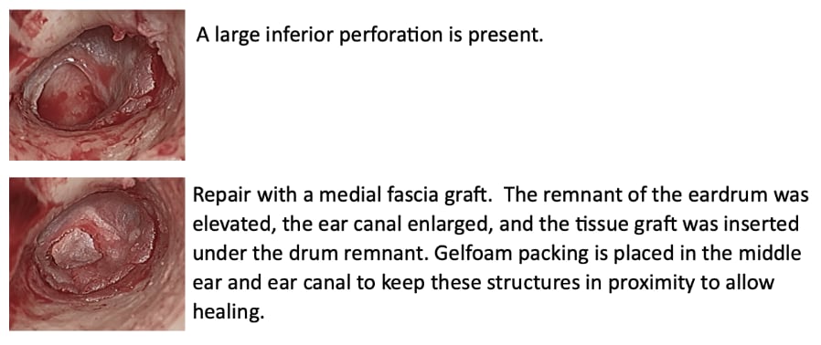 Medial Tympanoplasty Images