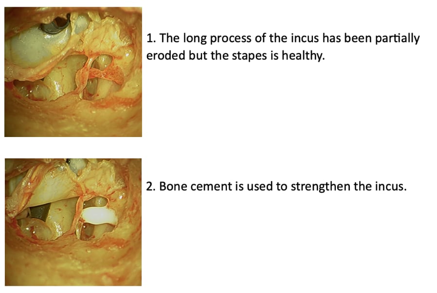 Ossicular Chain Reconstruction