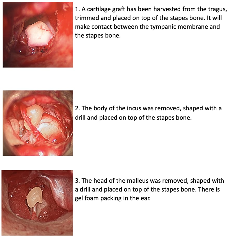 Cholesteatoma Removal