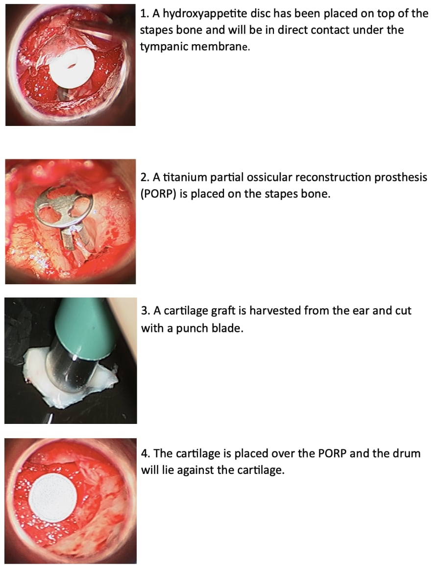 Protheses Used