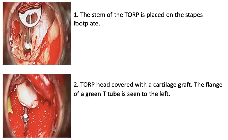 Ossicular Replacement Protheses