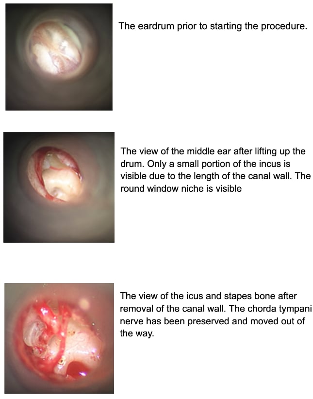 Stapedectomy