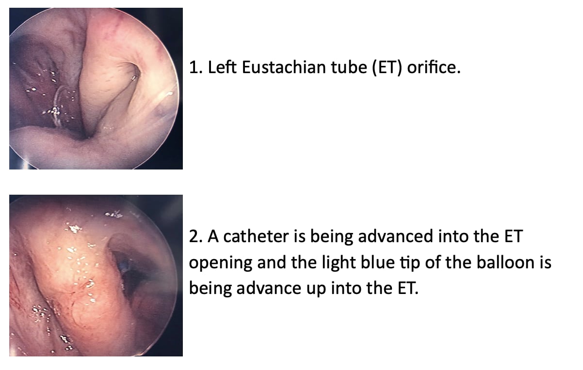 Submucosal Edema