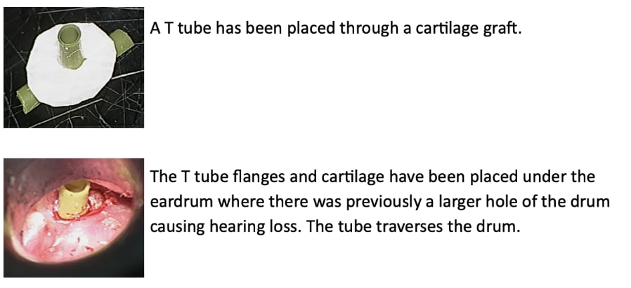 Ventilation Tube Insertion Images