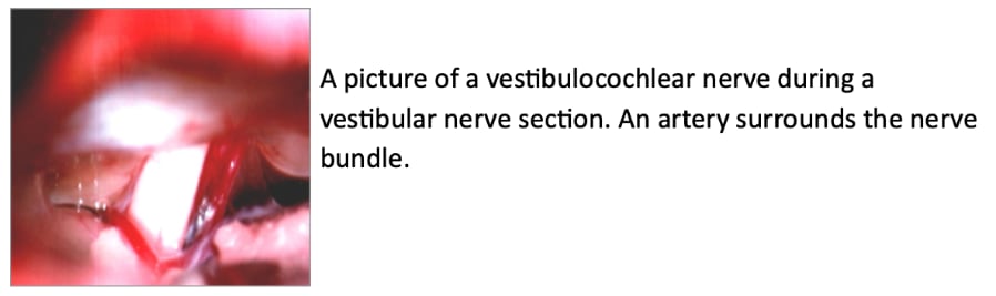 Vestibular Cochlear Nerve